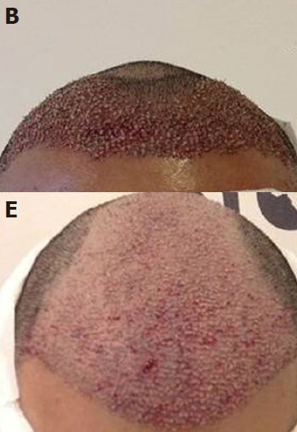 image of hair transplant close up immediately after surgery