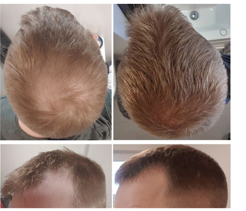 Male pattern baldness patient before and after Finasteride treatment for 9 months