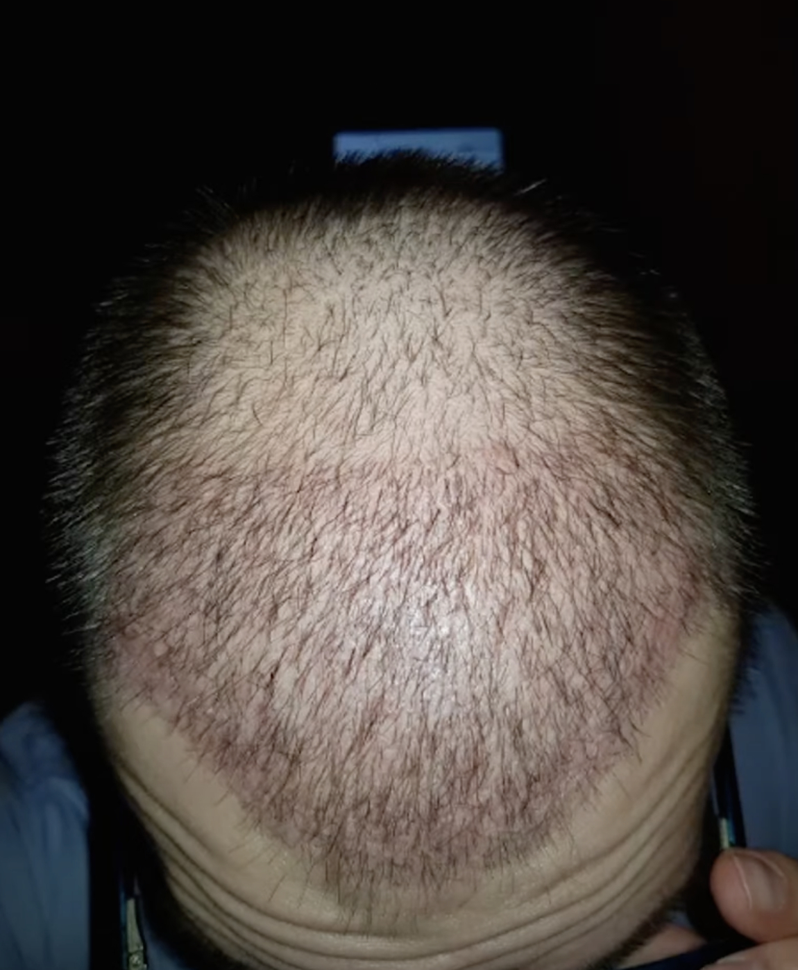 Light hair transplant shedding on day 24 post-FUE
