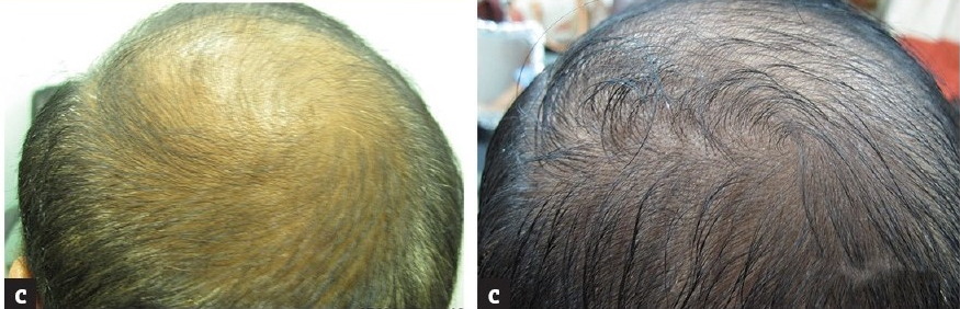 35-year-old patient before and after six months of derma rolling for hair.