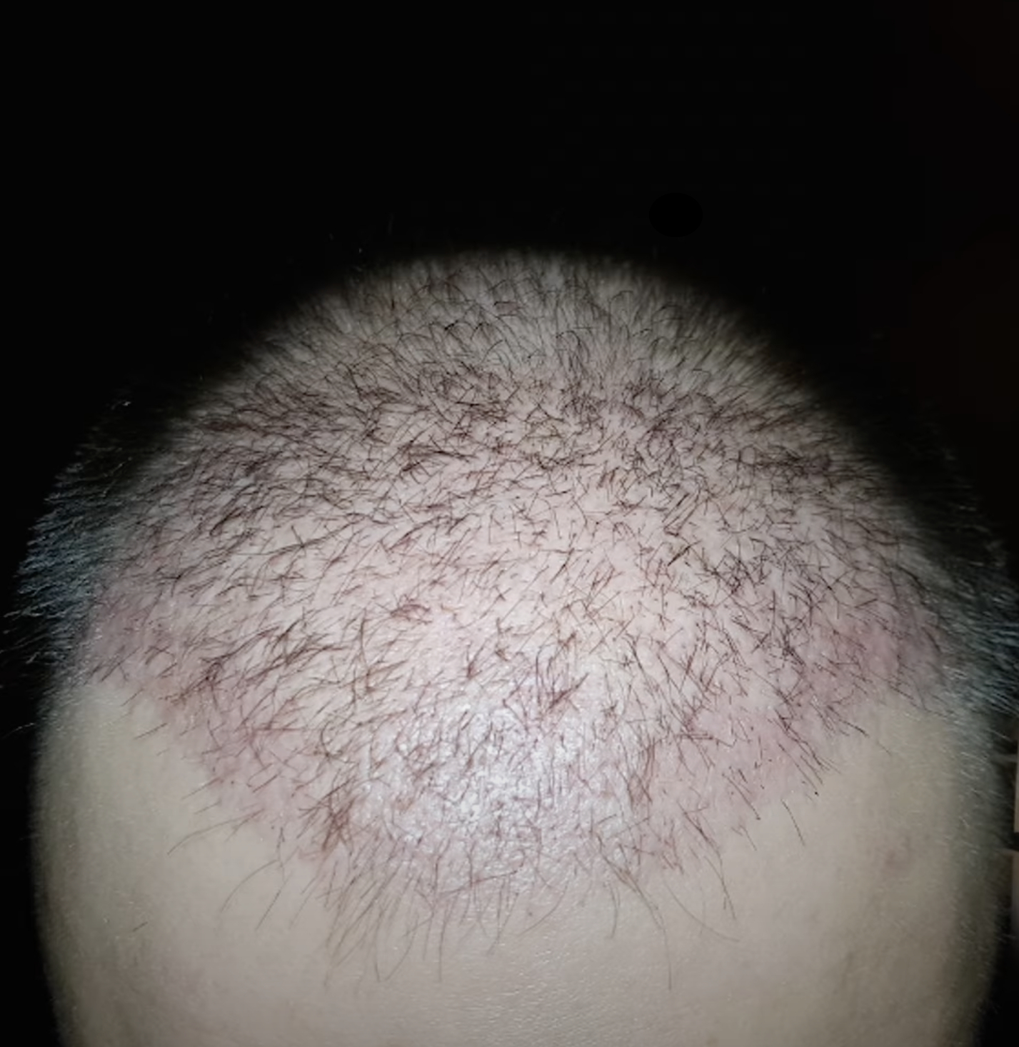Major hair transplant shedding 27 days after FUE 