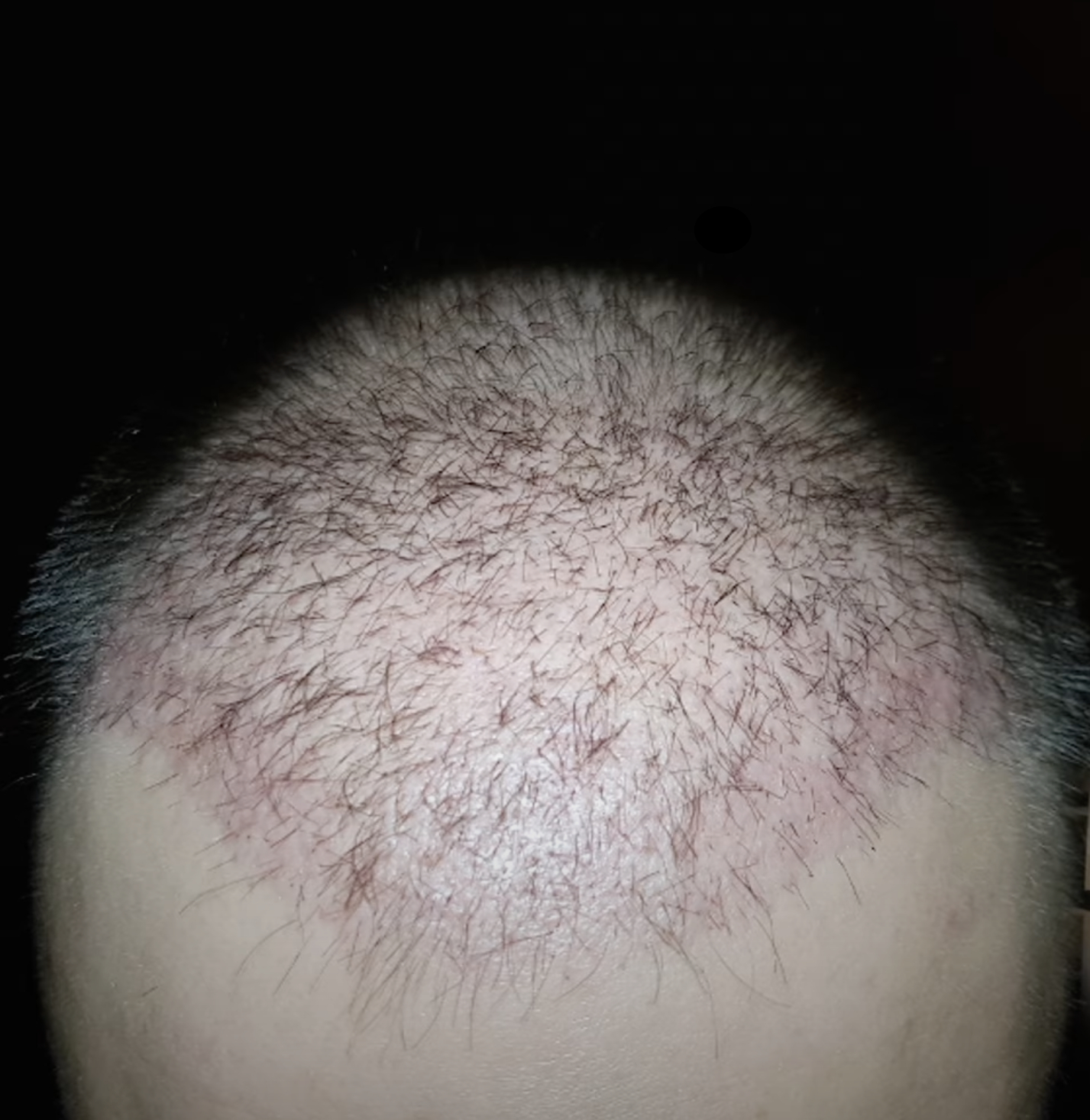 Major hair transplant shedding 27 days post-transplant