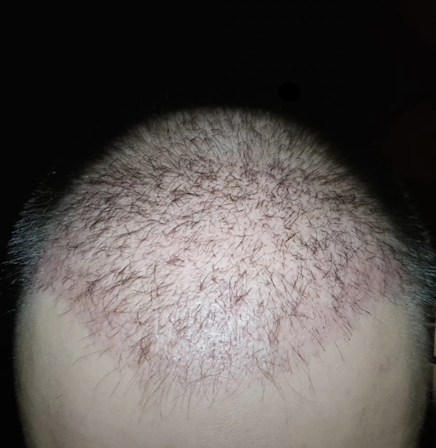 Patient with hair transplant shedding 27 days after FUE