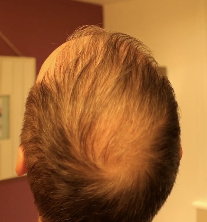 4 months after hair transplant - crown