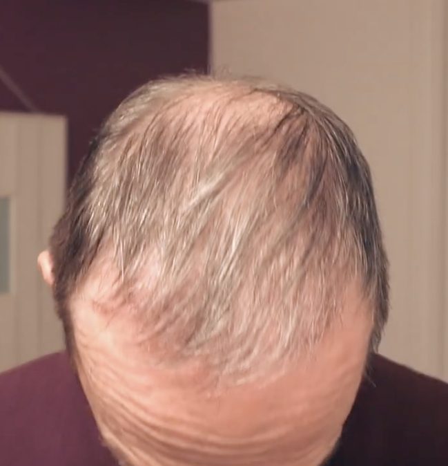 4 months after hair transplant - mid scalp