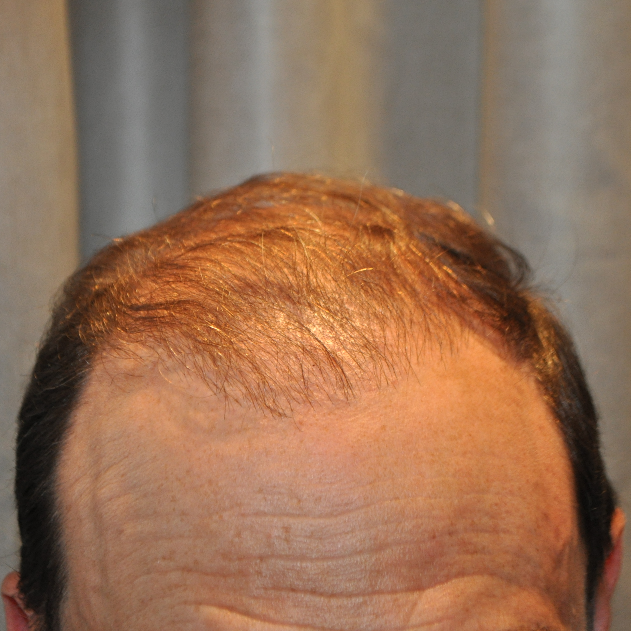 1500 Graft Hair Transplant: Coverage, Results, Costs, Wimpole Clinic