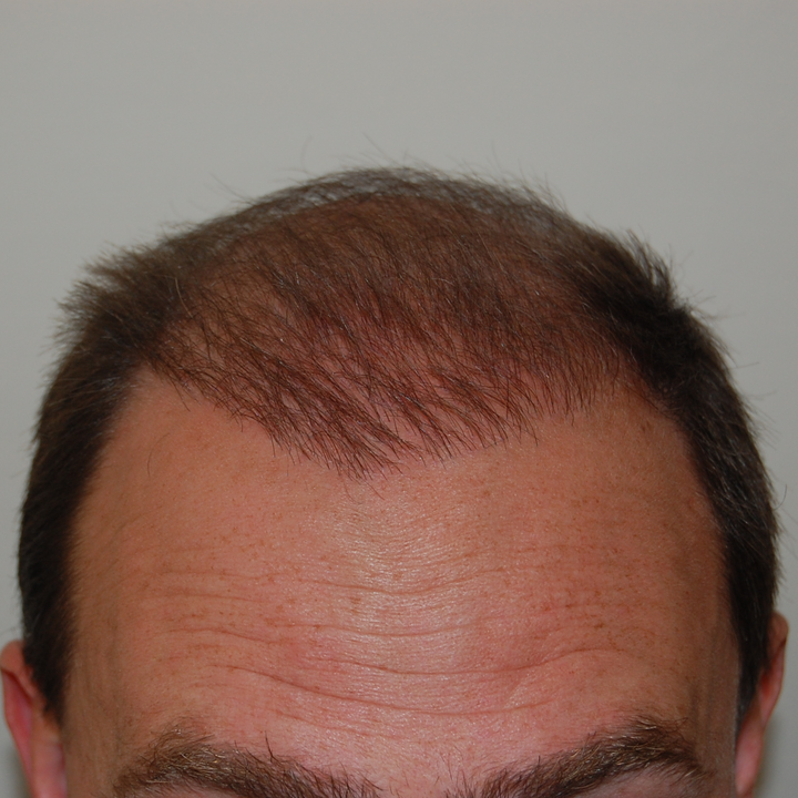 1500 Graft Hair Transplant Coverage, Results, Costs