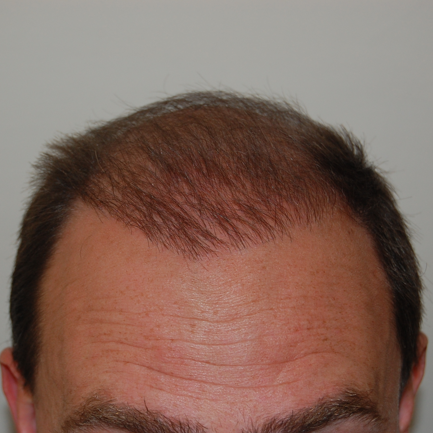 1500 Graft Hair Transplant: Coverage, Results, Costs, Wimpole Clinic