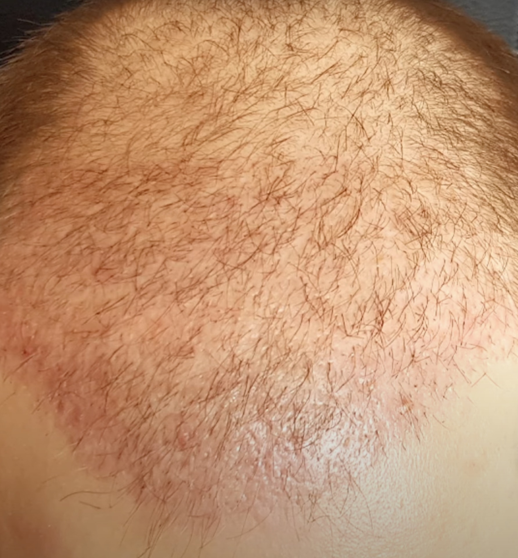 End of telogen phase at day 38 post-FUE