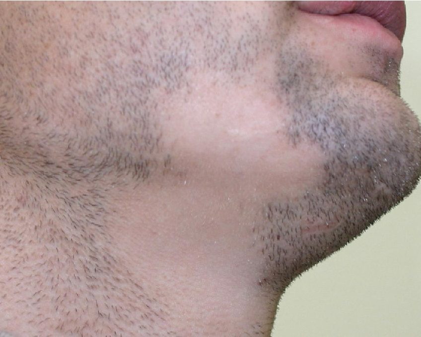 man with alopecia barbae