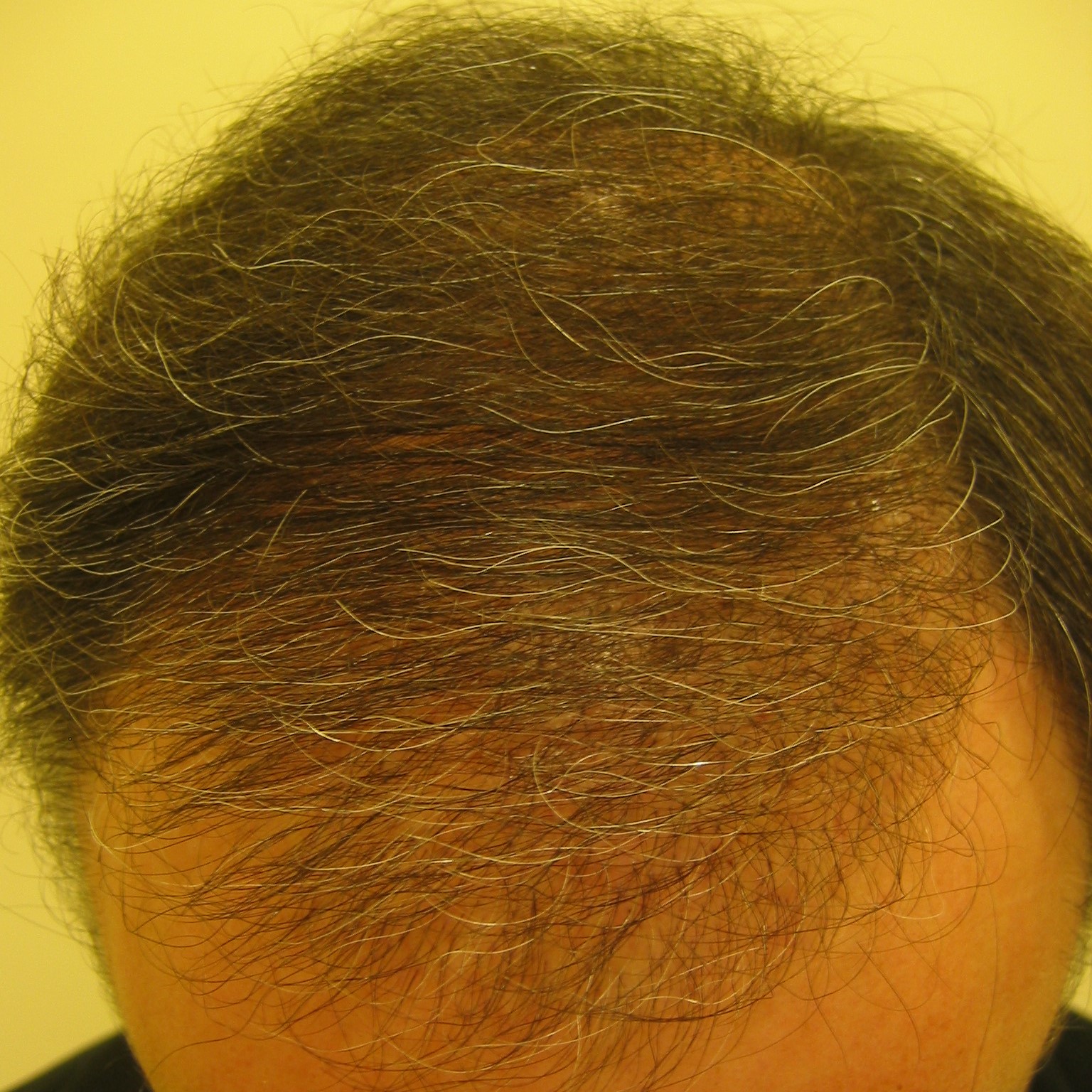 How Much Does A Receding Hairline Transplant Cost?, Wimpole Clinic