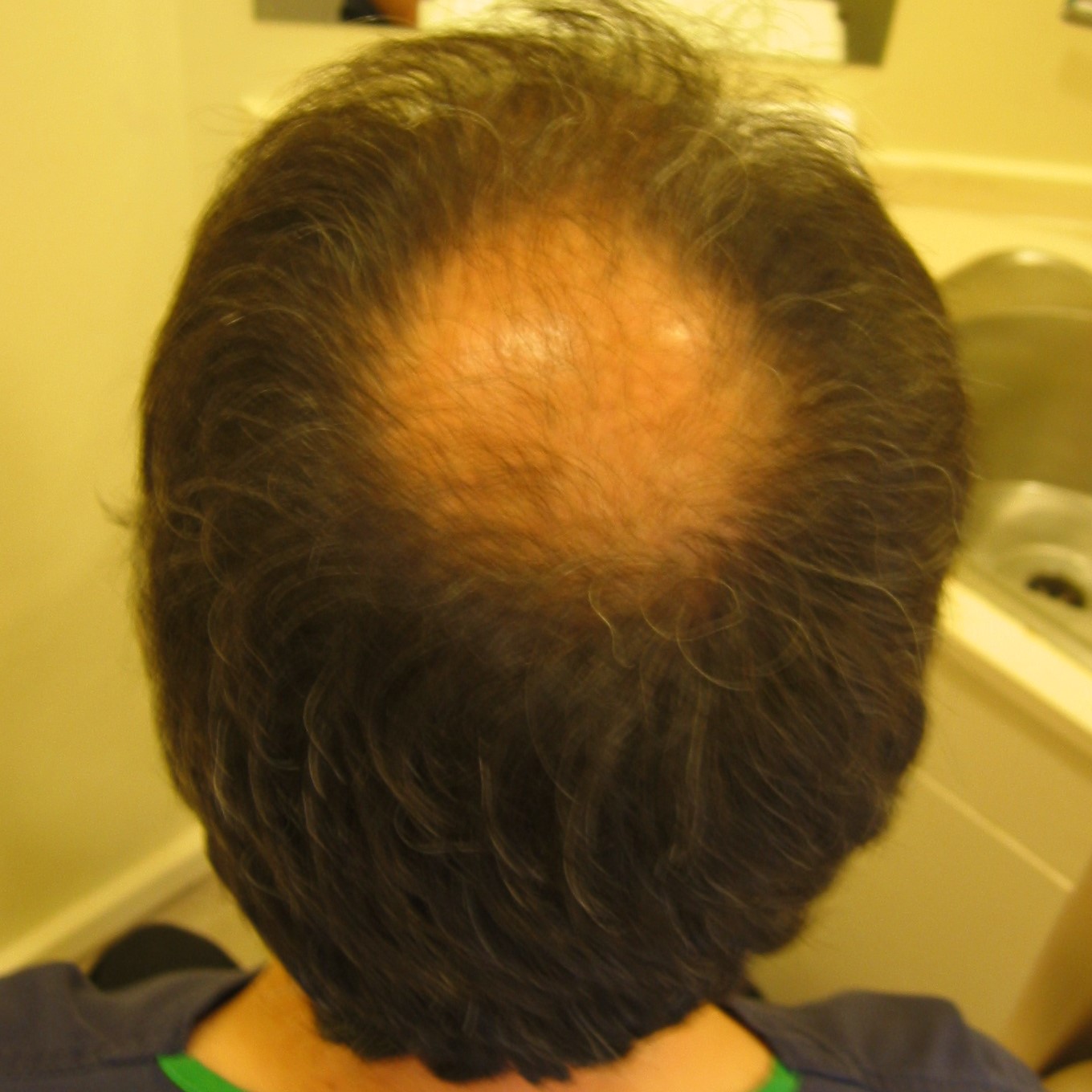 Bald Spot on Crown: How to Spot it and How to Stop it, Wimpole Clinic