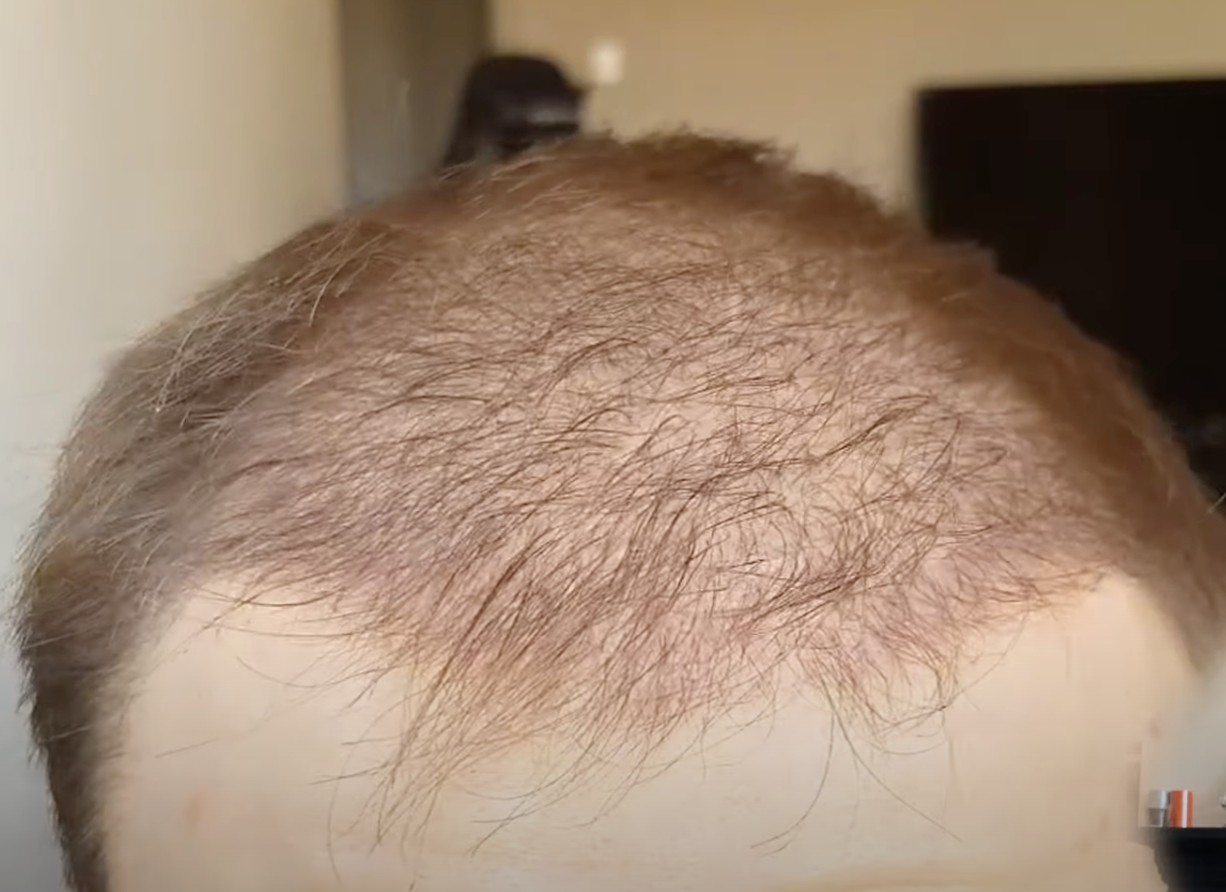 Hair regrowth 4 months after hair transplant