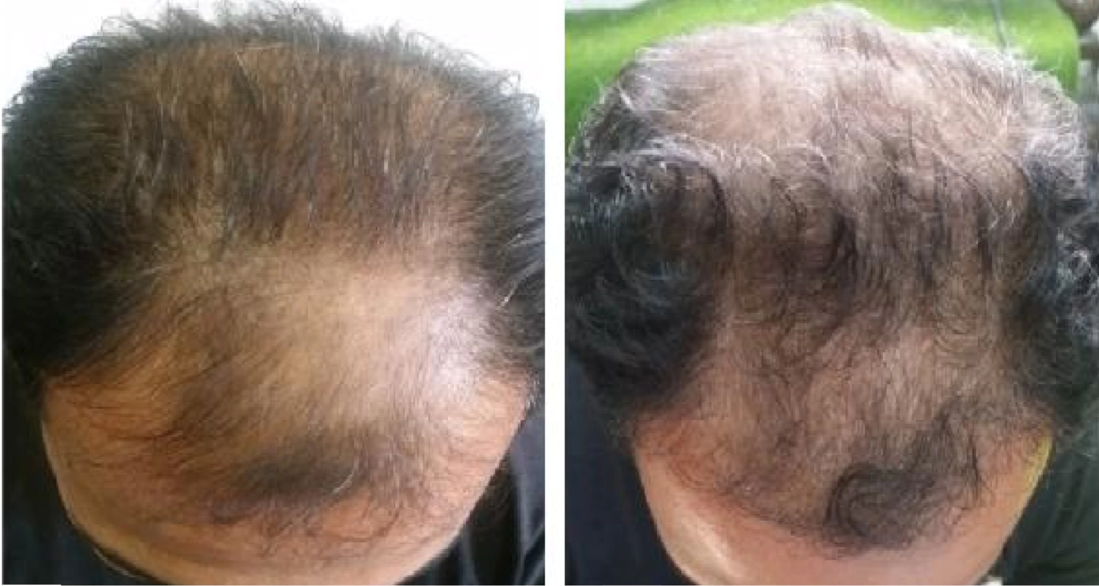 Patient before and after 6 months of using Dutasteride and micro-needling