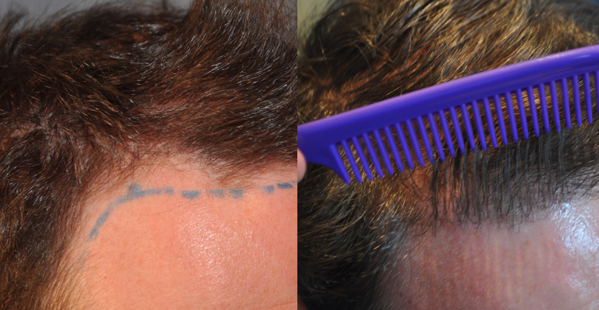 Patient's right temple before and after 600 grafts hair transplant