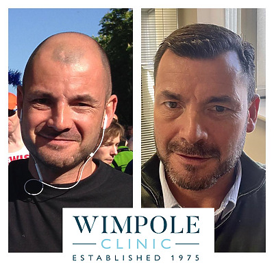 Biofibre Hair Transplants: Everything You Need To Know, Wimpole Clinic