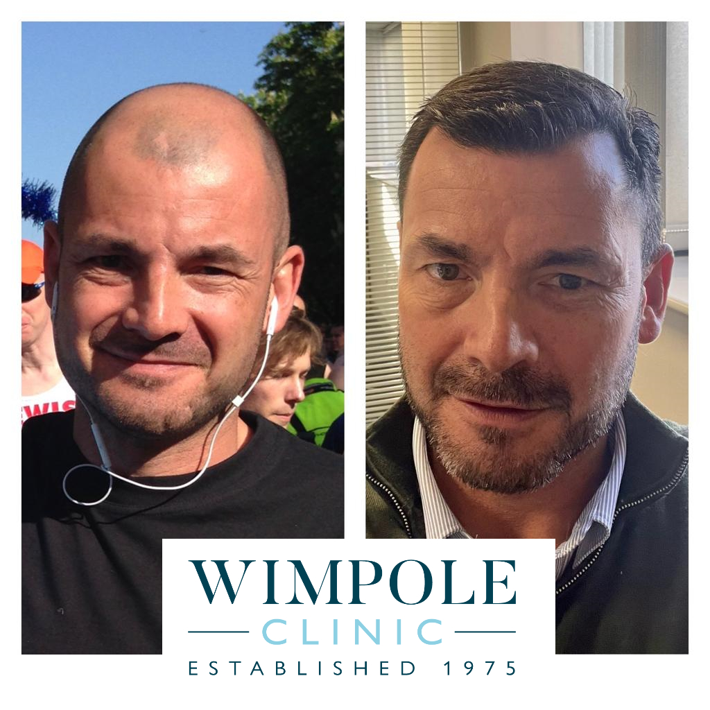 Wimpole patient before and after 6,200-graft hair transplant