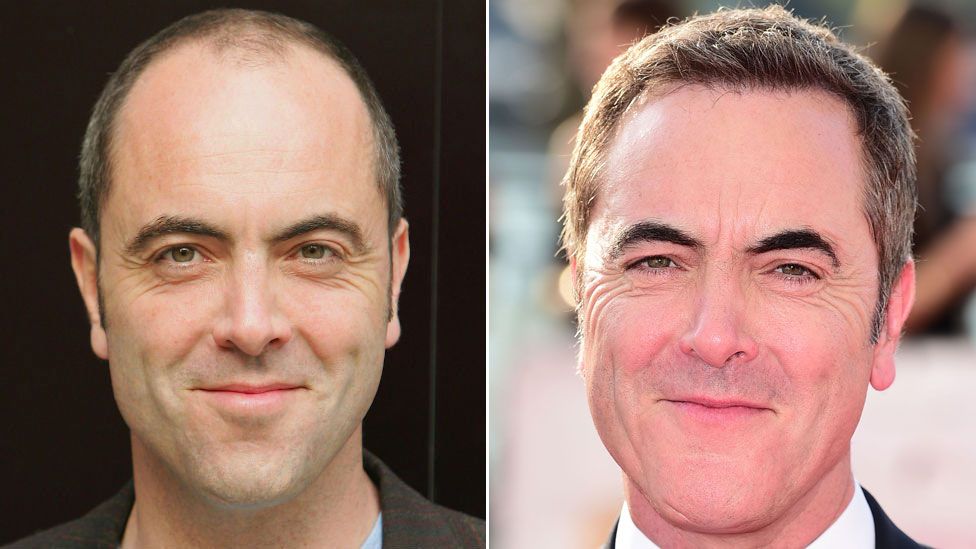 James Nesbitt before and after multiple hair transplant procedures to correct male pattern baldness