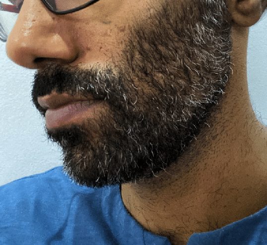 dense beard with light patchiness
