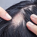 Alopecia Areata: Causes, Diagnosis & Treatment