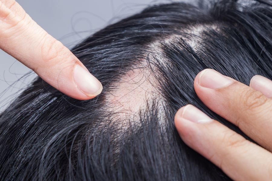 Hair Loss in Women: Types, Causes, Treatments