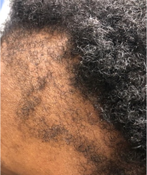 Example of a patient with advanced traction alopecia