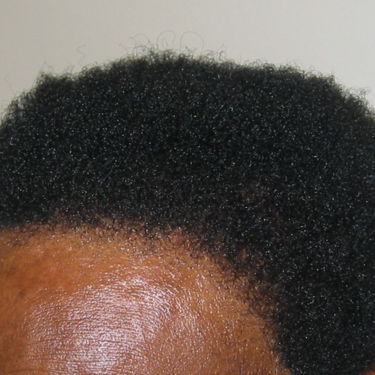 FUE Vs FUT: What’s The Difference?, Wimpole Clinic