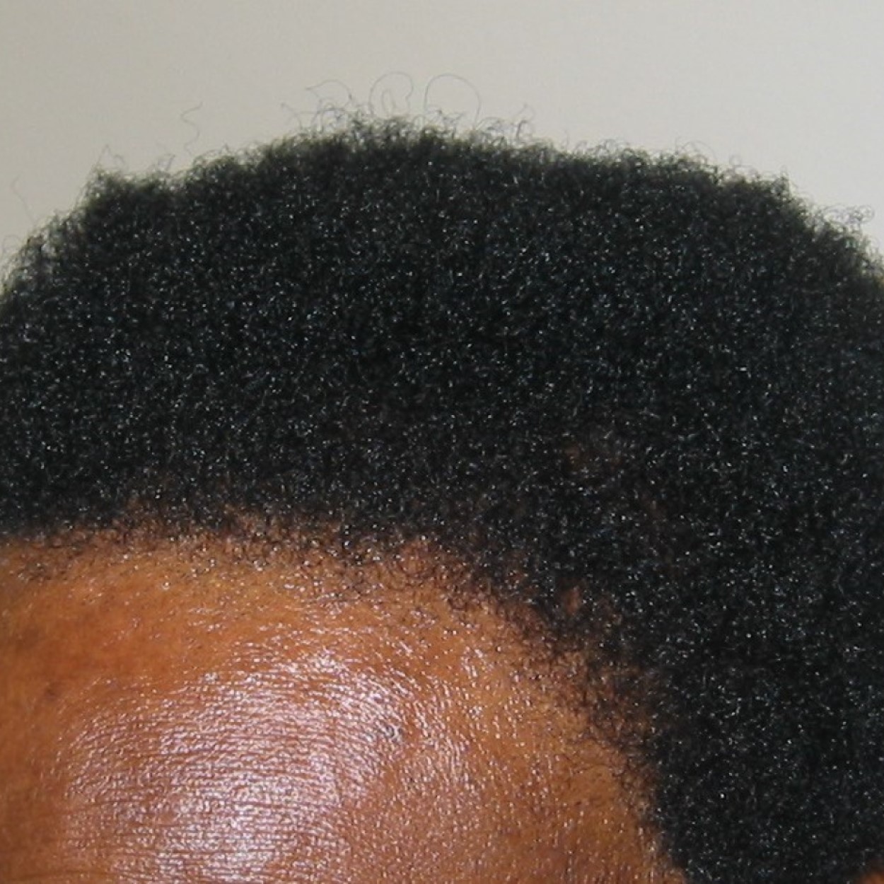 Afro Hair Transplant, Wimpole Clinic