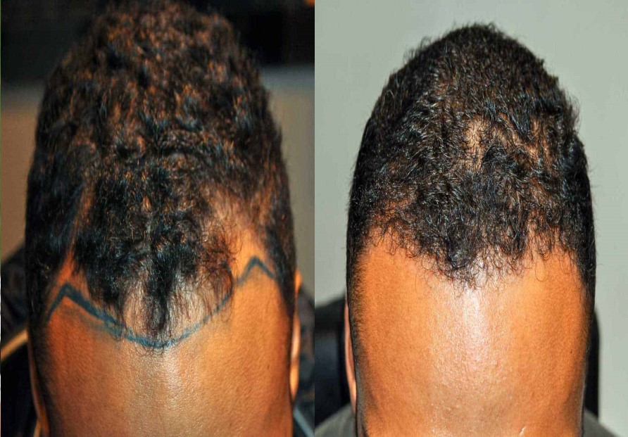 before and after FUE afro hair transplant