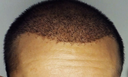 Afro hairline transplant after 3 weeks