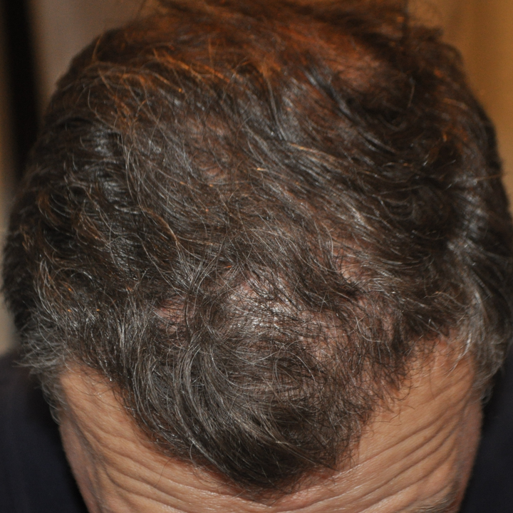 Norwood Stage 4 Photos, Treatments, Results Wimpole Clinic