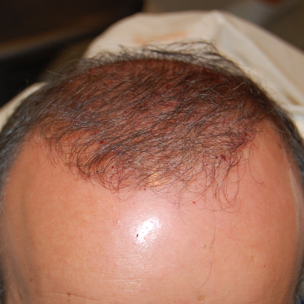 Hair Transplant Timeline: Preparation, Recovery &#038; Results, Wimpole Clinic