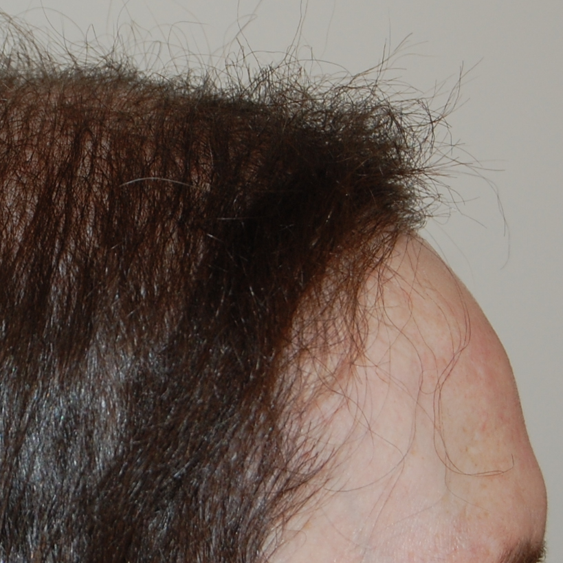 How Many Hair Grafts Do I Need? | Wimpole Clinic