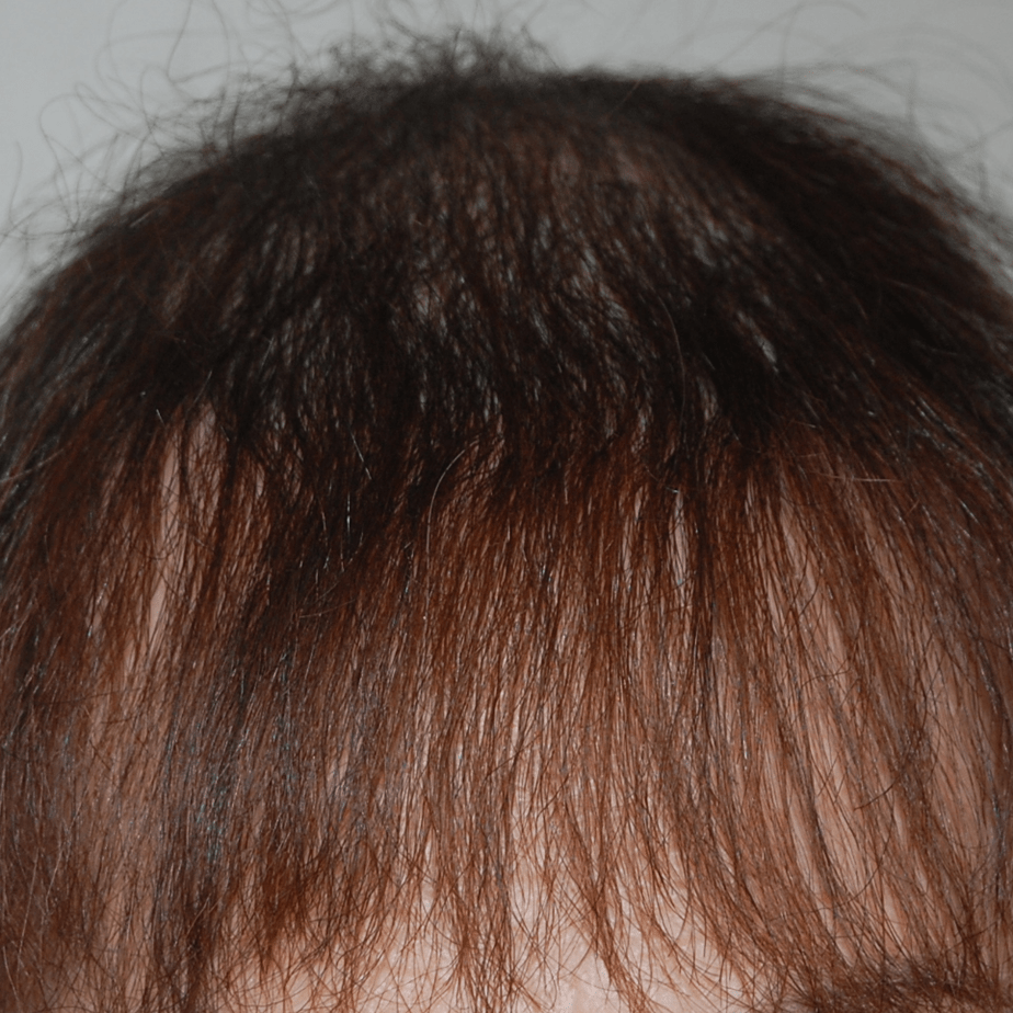 How Many Hair Grafts Do I Need?, Wimpole Clinic