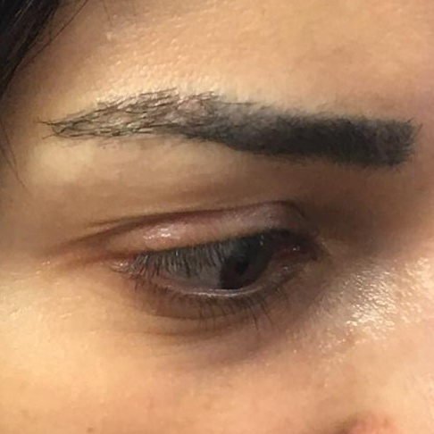 Eyebrow Transplant, Wimpole Clinic