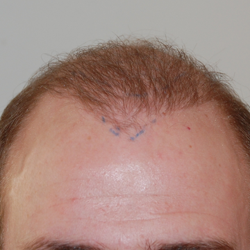 Hair Transplant After 6 Months: Photos, Results, Side Effects