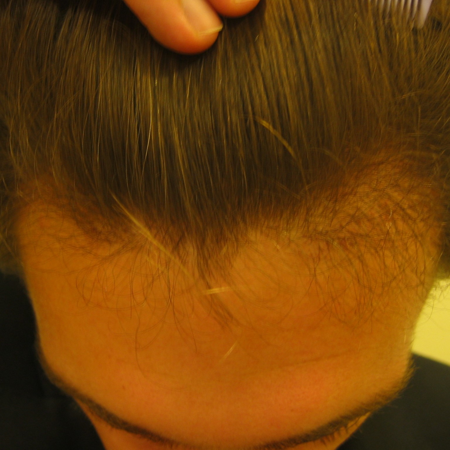 Hair Transplant After 4 Months: Photos, Results, Side Effects, Wimpole Clinic