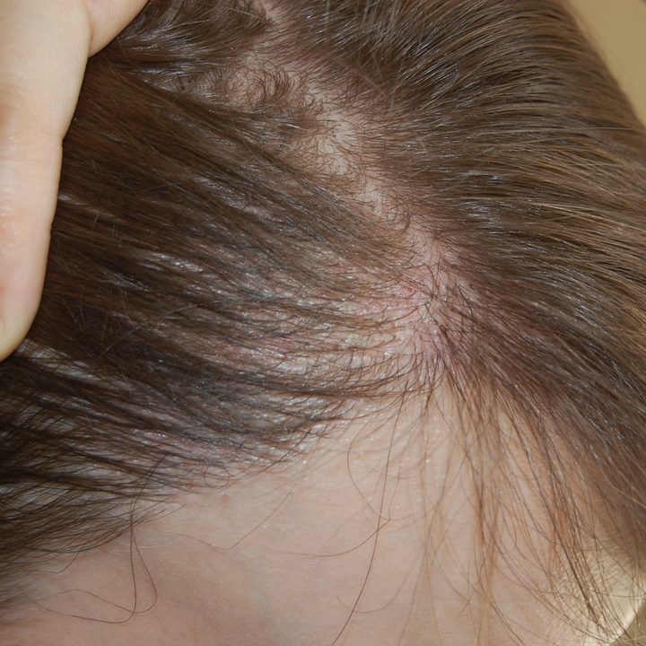 Hair Transplant After 6 Months: Photos, Results, Side Effects