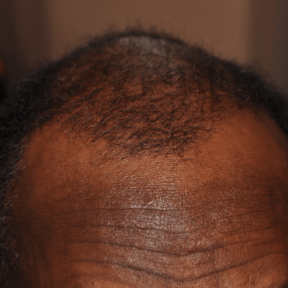 How Much Does A Receding Hairline Transplant Cost?, Wimpole Clinic