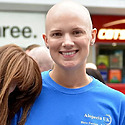 Can You Get Alopecia Areata Treatment On The NHS?