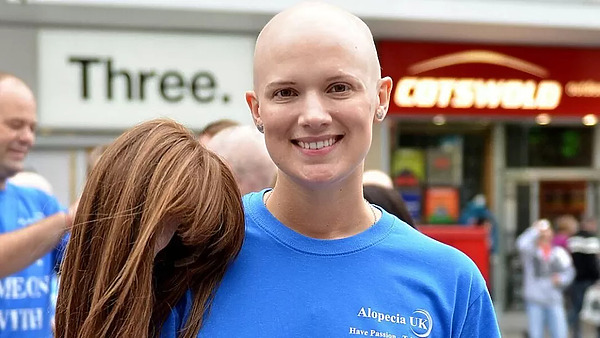 Can You Get Alopecia Areata Treatment On The NHS?