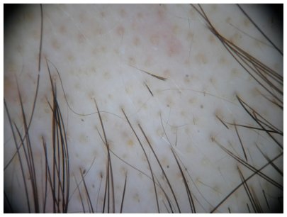 Alopecia Areata yellow dots and exclamation mark hairs