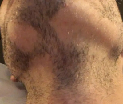 Example of alopecia barbae