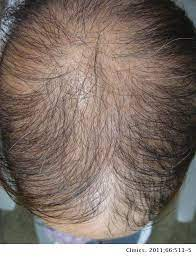 Alopecia incognita