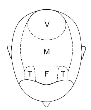 Areas of the scalp typically affected by male pattern baldness
