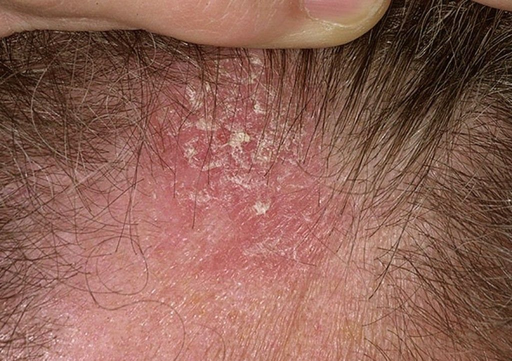 Recurring Scab On Scalp In The Same Spot Causes Prevention Treatment 5485