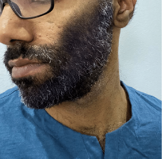 dense beard with light patchiness after use of hair fibres
