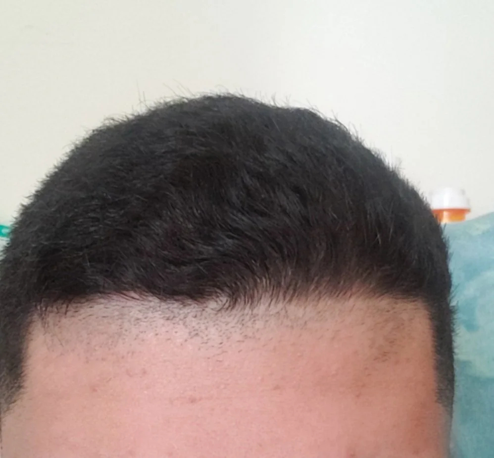 How To Fix A Messed Up Hairline, Wimpole Clinic