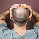 How To Regrow Hair On Bald Spot Fast