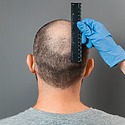 Bald Spot On Crown: How To Spot It And How To Stop It